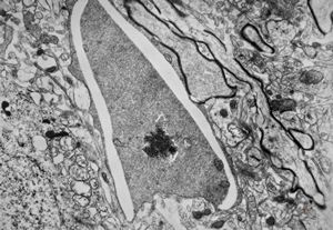 F,15y. | infantile neuroaxonal dystrophy (Seitelberger)